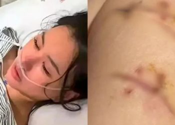 Salva pelo silicone – Mulher sobrevive a 22 facadas no peito graças a implante