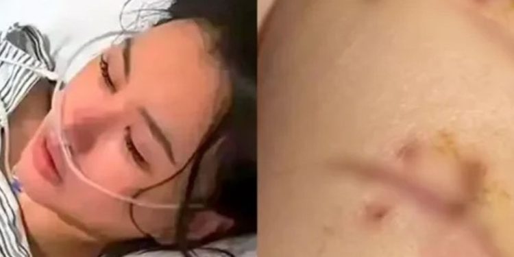 Salva pelo silicone – Mulher sobrevive a 22 facadas no peito graças a implante