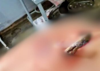 No Amazonas, homem fica com faca cravada nas costas após ser atacado pelo ex da namorada