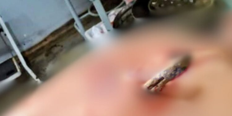 No Amazonas, homem fica com faca cravada nas costas após ser atacado pelo ex da namorada