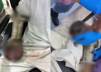 Veja como ficou o braço de açougueiro que foi sugado por moedor de carne