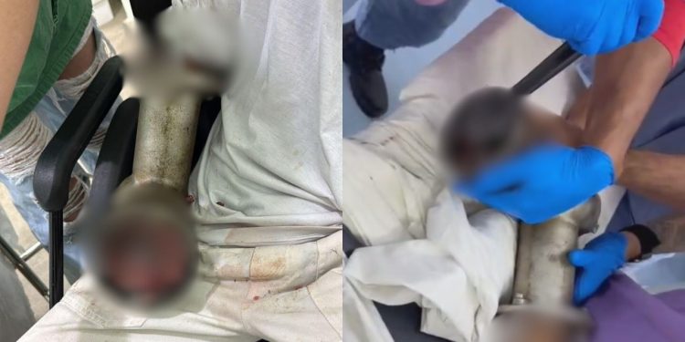 Veja como ficou o braço de açougueiro que foi sugado por moedor de carne