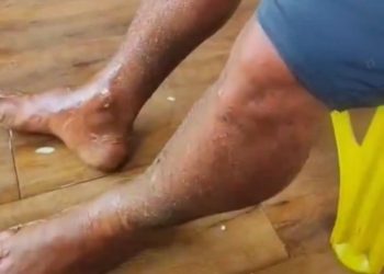 IMAGENS FORTES! Após explosão de balsa homem fica desfigurado