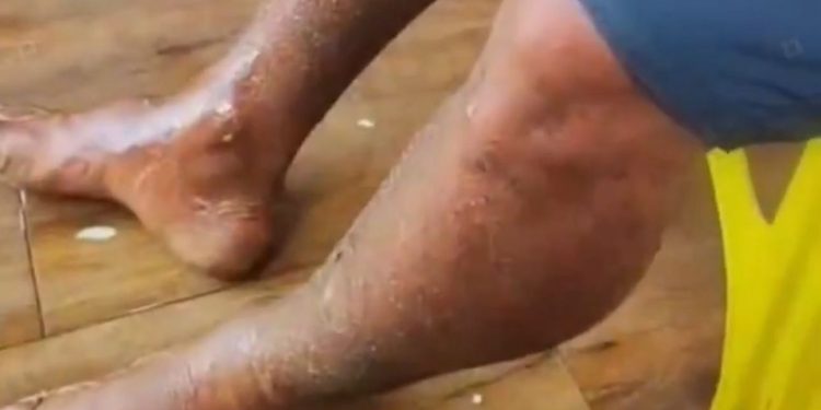 IMAGENS FORTES! Após explosão de balsa homem fica desfigurado