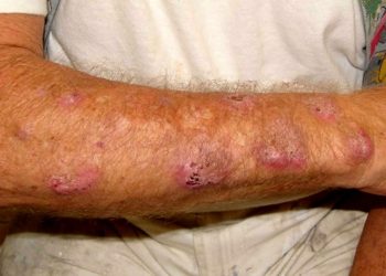 Primeira morte humana por esporotricose é confirmada no Amazonas