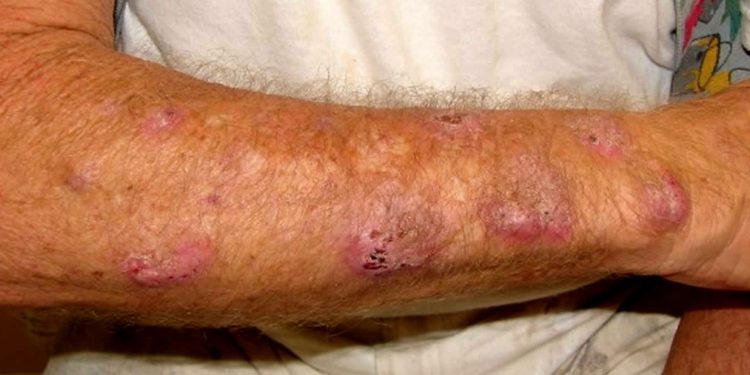 Primeira morte humana por esporotricose é confirmada no Amazonas