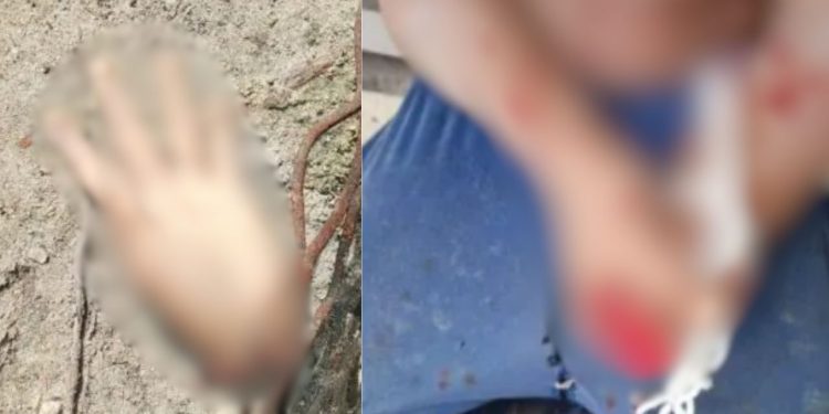 Polícia investiga caso de homem que teve a mão decepada em Maués