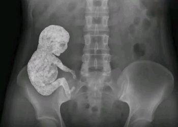 Litopédion – O corpo que “transforma” o feto em pedra