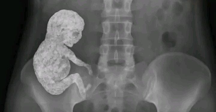 Litopédion – O corpo que “transforma” o feto em pedra