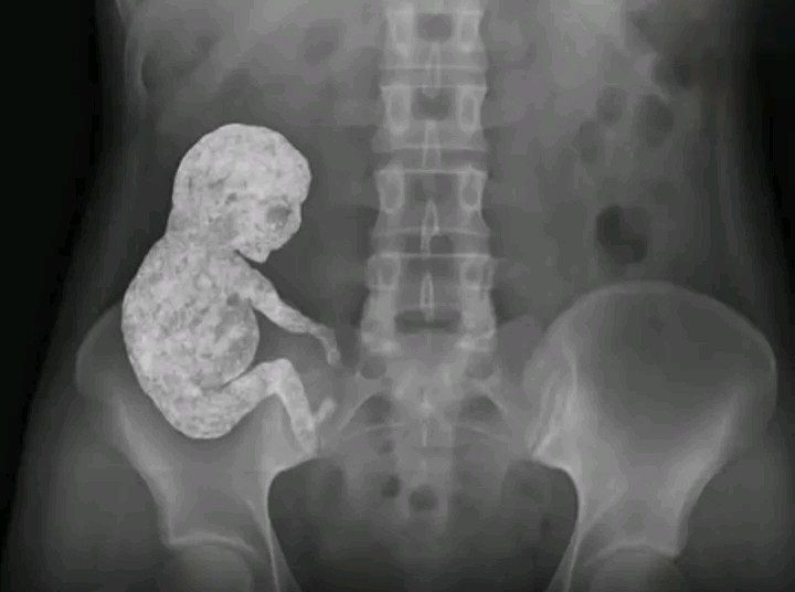 Litopédion – O corpo que “transforma” o feto em pedra
