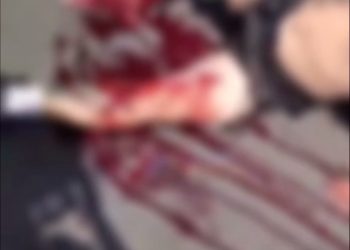 Vídeo. Motociclista tem fratura exposta em acidente no Planalto