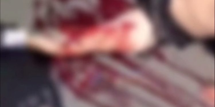 Vídeo. Motociclista tem fratura exposta em acidente no Planalto