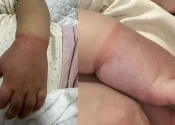 Em Manaus, menina de 2 anos quase perde o braço após elástico prender circulação