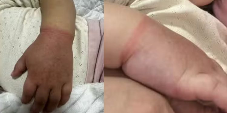 Em Manaus, menina de 2 anos quase perde o braço após elástico prender circulação