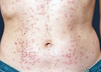 “DEZEMBRO VERMELHO” – Triplicam números  de casos de AIDS em Manaus