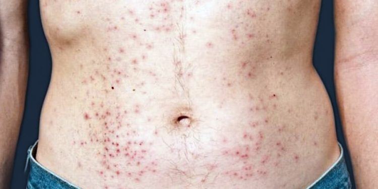 “DEZEMBRO VERMELHO” – Triplicam números de casos de AIDS em Manaus