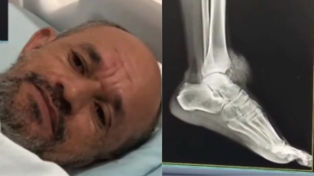 Em Presidente Figueiredo, homem acusa PM de baleá-lo no pé durante operação