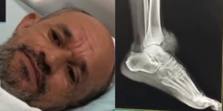 Em Presidente Figueiredo, homem acusa PM de baleá-lo no pé durante operação