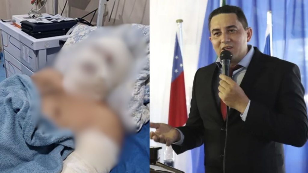 Explosão em lancha deixa ex-prefeito de Borba com queimaduras em 30% do corpo