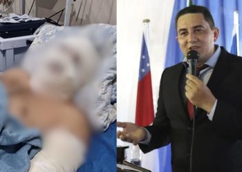 Explosão em lancha deixa ex-prefeito de Borba com queimaduras em 30% do corpo