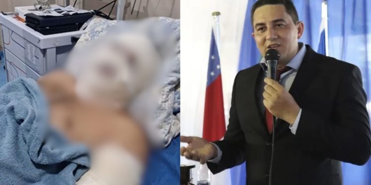 Explosão em lancha deixa ex-prefeito de Borba com queimaduras em 30% do corpo