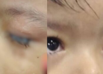 Menino de 2 anos é levado às pressas ao hospital após ter olhos colados por cola industrial