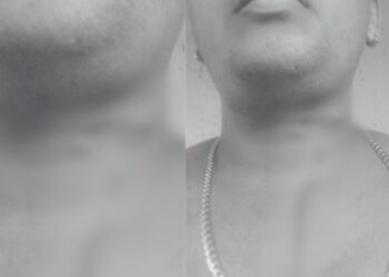 Alerta: Linha com cerol quase ‘tora’ pescoço de jovem no Educandos