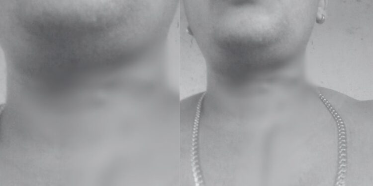 Alerta: Linha com cerol quase ‘tora’ pescoço de jovem no Educandos