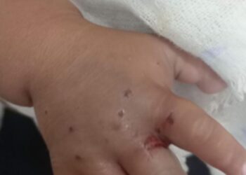 Após ser picado por cobra em Maués, bebê de 1 ano é transferido para Manaus