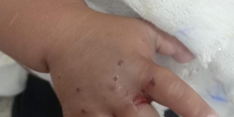 Após ser picado por cobra em Maués, bebê de 1 ano é transferido para Manaus