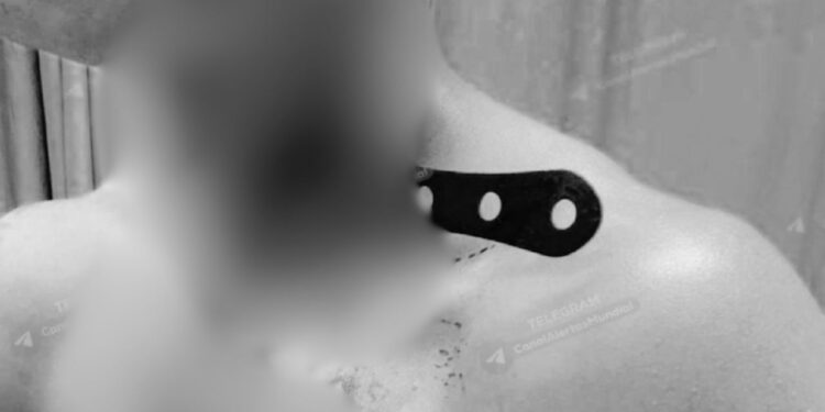 Mesmo depois de levar uma facada no pescoço, ladrão sobrevive