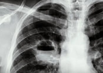Acidente  – Engoliu camisinha na hora do “rala e rola” e quase pega tuberculose