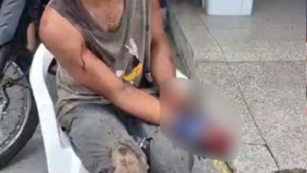 Após passar pelo 'Tribunal do crime', morador de rua tem dedos 'torados' em Manaus