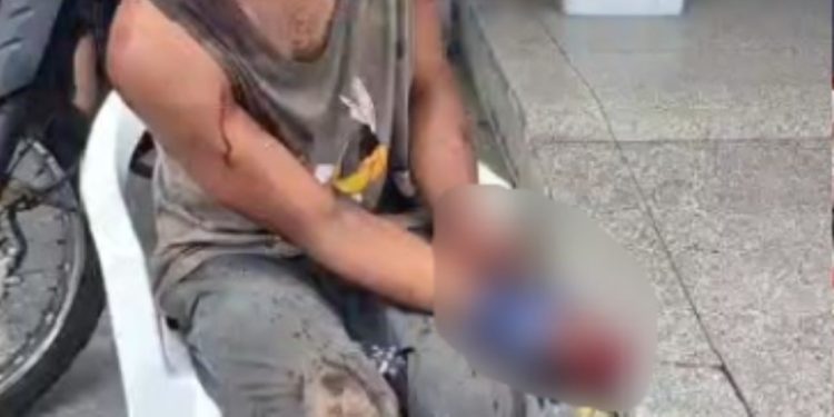 Após passar pelo 'Tribunal do crime', morador de rua tem dedos 'torados' em Manaus