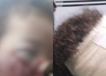 Ataque de cachorro deixa criança de 3 anos ferida no rosto em Manaus
